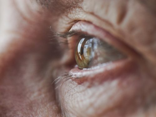 alzheimer näkyy silmistä
